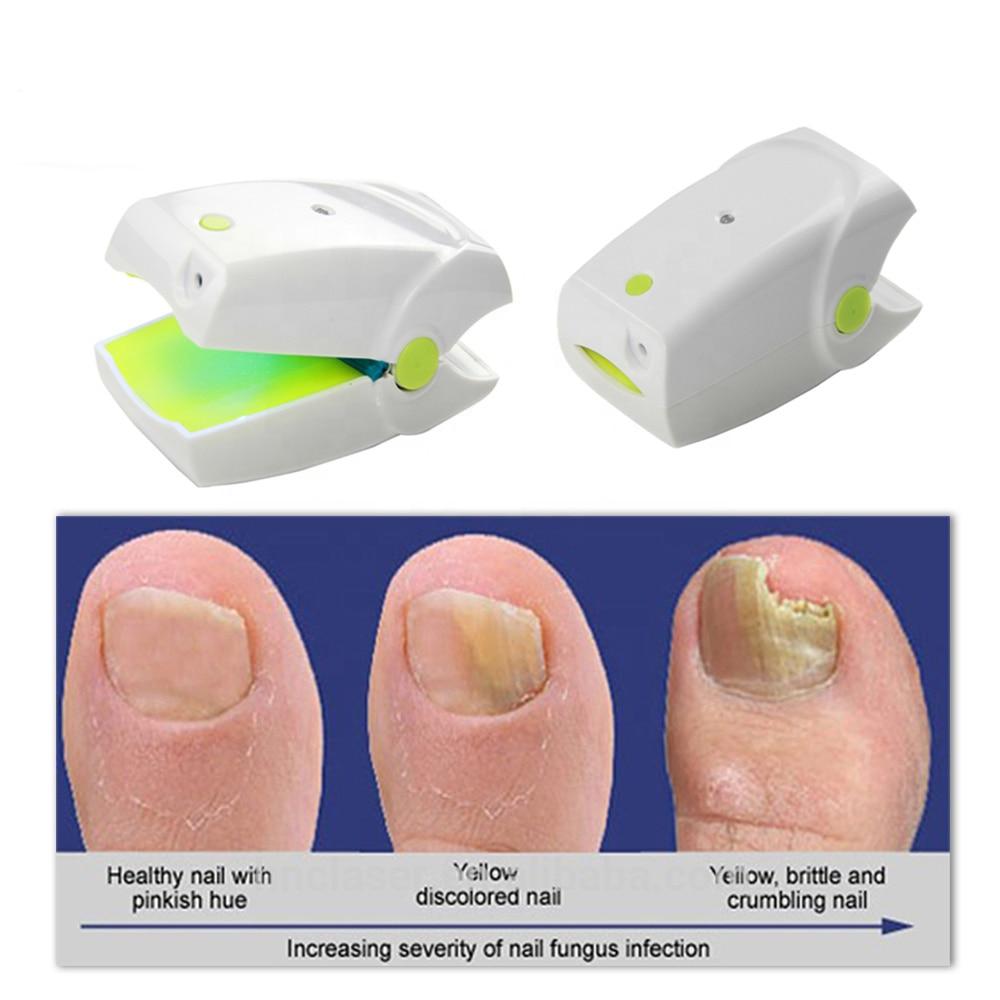 905NM Painless Nail Fungus Treatment Instrument Laser Feet Infrared Foot Care Whitening Toe Removal anti-infective onychomycosis