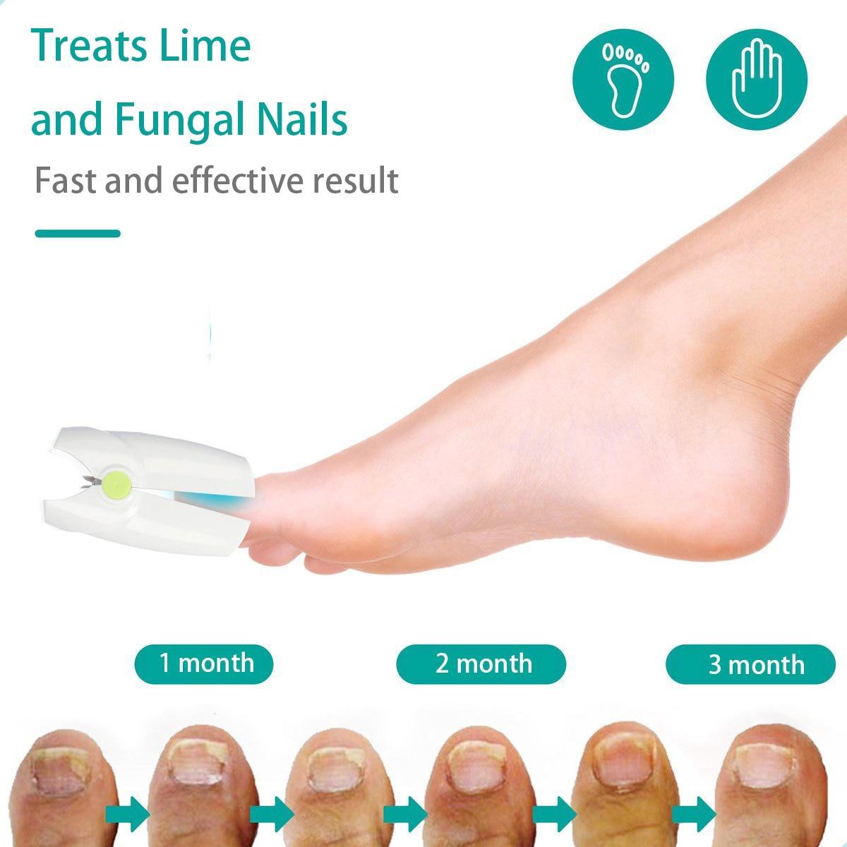 905NM Painless Nail Fungus Treatment Instrument Laser Feet Infrared Foot Care Whitening Toe Removal anti-infective onychomycosis