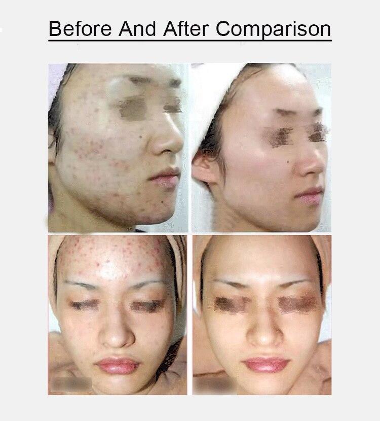 Portable 6 In 1 Facial Cleansing hydra-facial Smart skin analyze Deep Pore Vacuum Hydra Skin Lift Anti-aging Beauty Machine